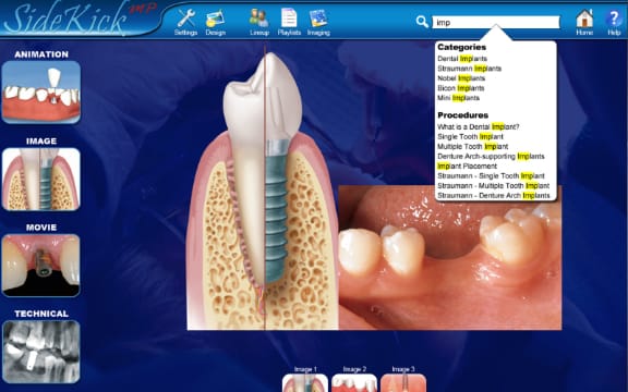 Cloud-based Dental SideKick interface showing an implant animation and image library